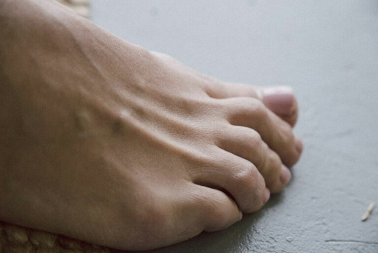crooked-toes