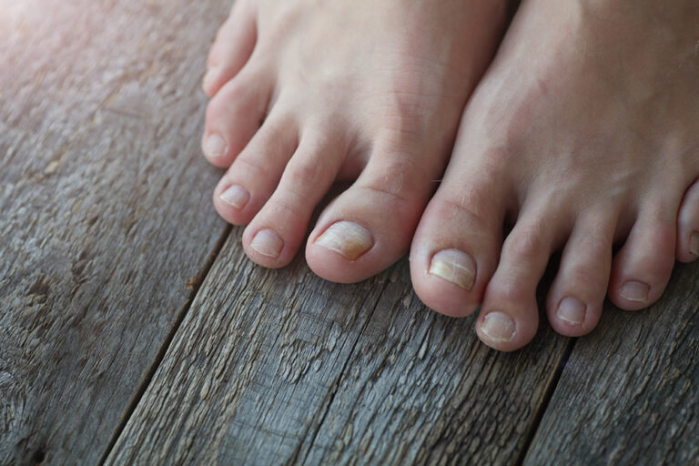 nail-fungus